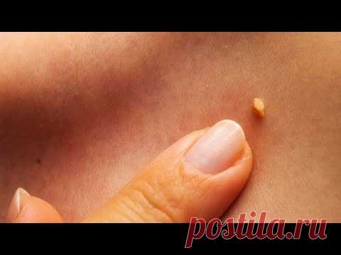 За 2-3 дня убрать ПАПИЛЛОМЫ и БОРОДАВКИ.