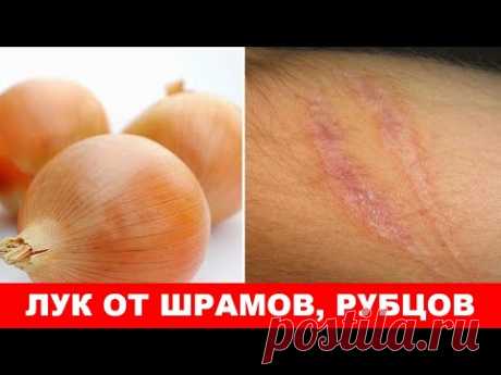 ЛУК от шрамов, рубцов, следов АКНЕ