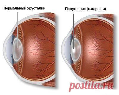Наше здоровье  КАТАРАКТА