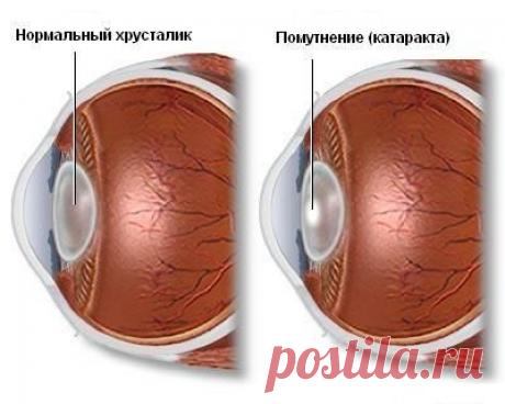 Наше здоровье  КАТАРАКТА