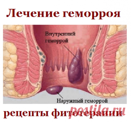 Лечение геморроя, рецепты фитотерапии | Советы целительницы