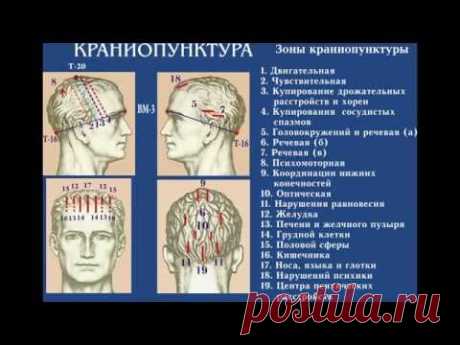 Краниопунктура. Дистанционное обучение иглотерапии (акупунктуре).