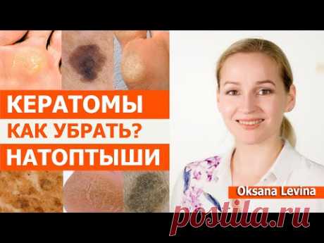Кератомы и натоптыши как убрать. Есть отличное средство