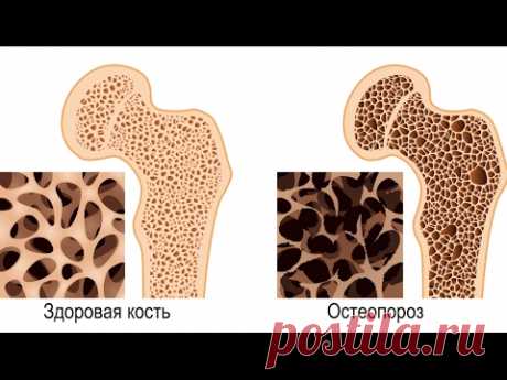 УКРЕПИ КОСТИ И ОСТЕОПОРОЗА НЕ БУДЕТ! 3 сильнейших продукта