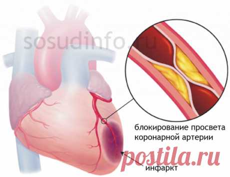 Реабилитация после инфаркта: жизнь, питание, диета, инвалидность, работа...