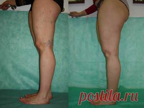 Ваши ножки "вздохнут" спокойно! Домашний курс избавления от ВАРИКОЗА! | Искусство