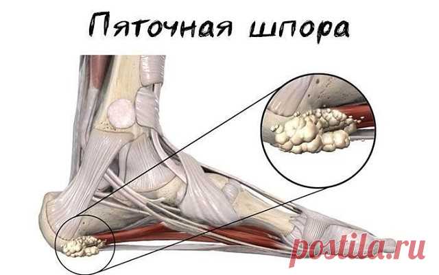 Пеленание от шпор | OK.RU