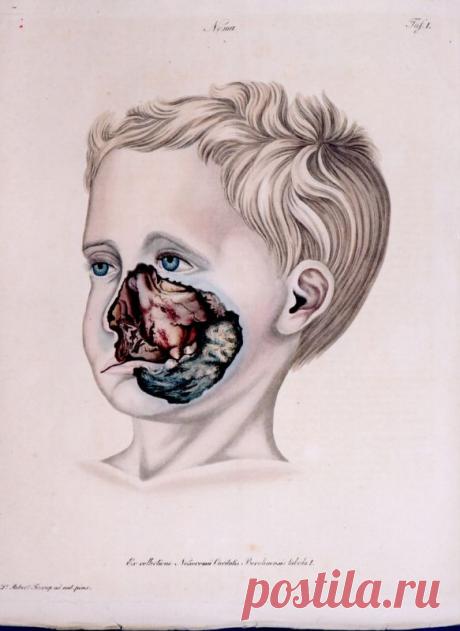 Нома (заболевание) — Википедия