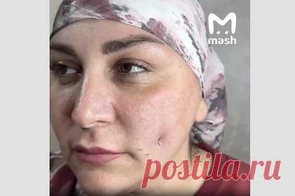 Женщины с Кавказа массово разрезали щеки ради ямочек