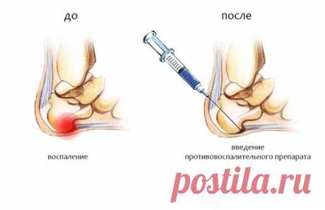 Пяточная шпора: причины, симптомы и лечение