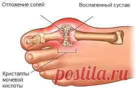 Подагра народное лечение болезни | Народная медицина