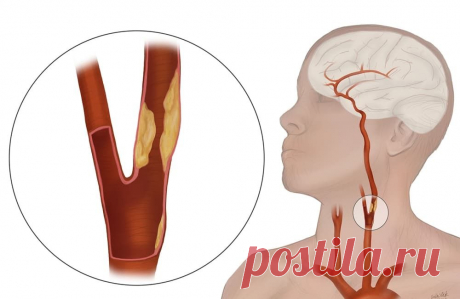 Высокое давление и шум в голове: возвращаем сосудам эластичность без лекарств