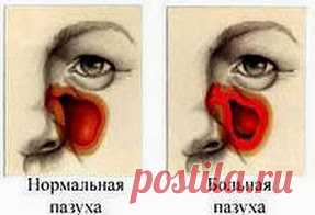 Чистотел очистит нос