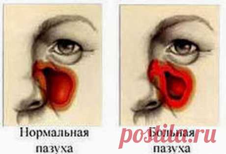 Чистотел очистит нос