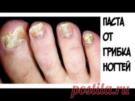 ШОК!!!Эта паста помогла мне БЫСТРО избавиться от грибка ногтей. Лечение грибка ногтей поможет вам избавиться от этой проблемы. Это средство от грибка ногтей ...
