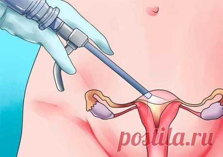 Лапароскопия матки: применение при различных заболеваниях