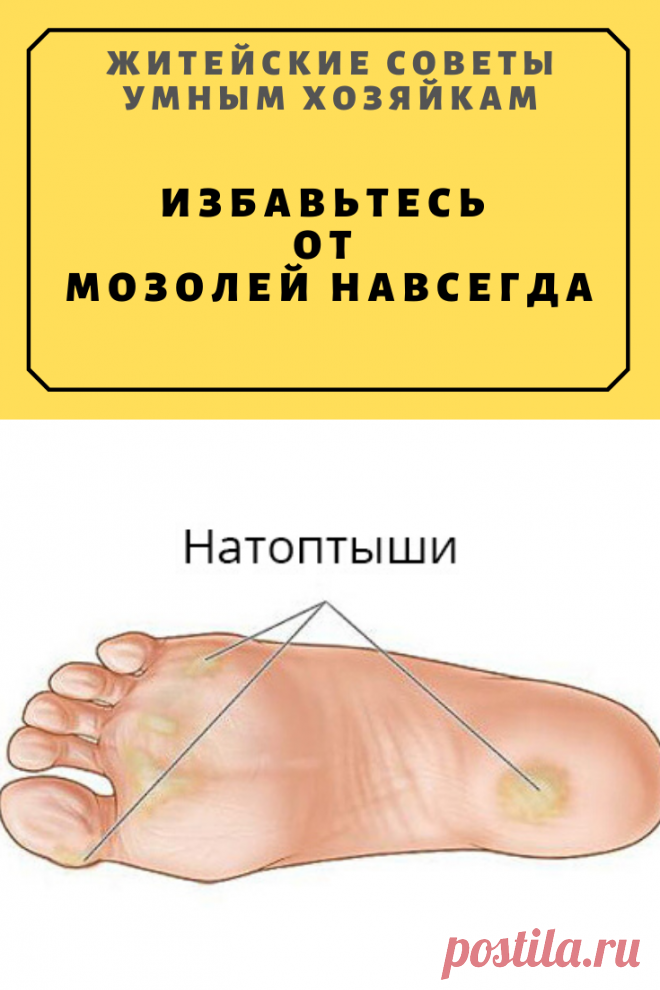 Избавьтесь от мозолей навсегда | Житейские Советы