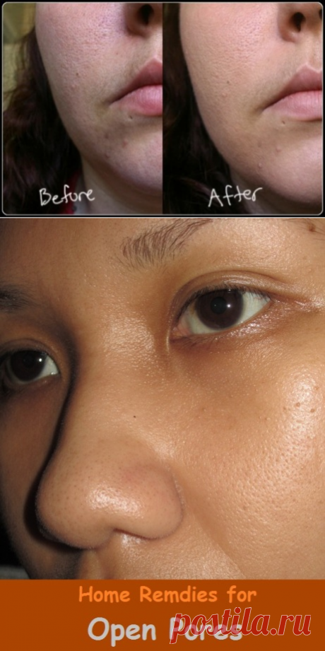 Home Remedies for Open Pores | Virtual Clinic