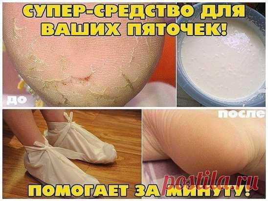 СУПЕР-СРЕДСТВО ДЛЯ ВАШИХ ПЯТОЧЕК! ПОМОГАЕТ ЗА МИНУТУ! 
И так..... Берём небольшую мисочку (такого размера, чтобы только поместились в неё ноги), наливаем 1,5 литра воды , чтобы была горяченькая, но не очень. Добавляем в воду 4 столовых ложки перекиси водорода. Ставим ноги в воду и сидим. Уже через несколько минут создаётся такое впечатление, что вы парили ноги по крайней мере полчаса. Если подошвы очень запущены, посидите подольше . Вы сами почувствуете эффект, когда потрёте нога об ногу, как о