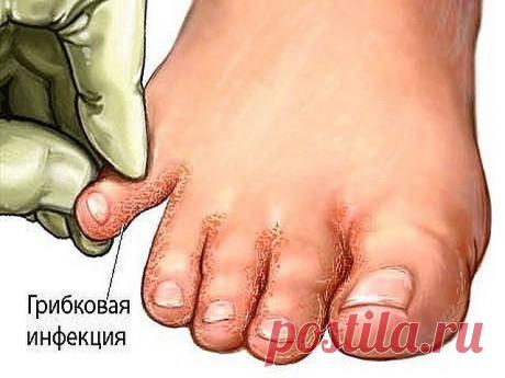 Многие не знают, что средства от грибка у них "под носом" Многие не знают, что средства от грибка у них "под носом"

Лечение грибка ногтей народными средствами является самым безопасным и дешёвым методом избавления от грибка. В этой статье я опишу несколько простых и эффективных рецептов для лечения грибка ногтей народными средствами.

Грибок ногтей - это инфекционное заболевание, которое очень легко передаётся от человека к человеку. Способов передачи грибка множество - э...