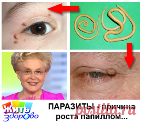 Папилломы и бородавки уходят за 10 дней! - Елена Малышева