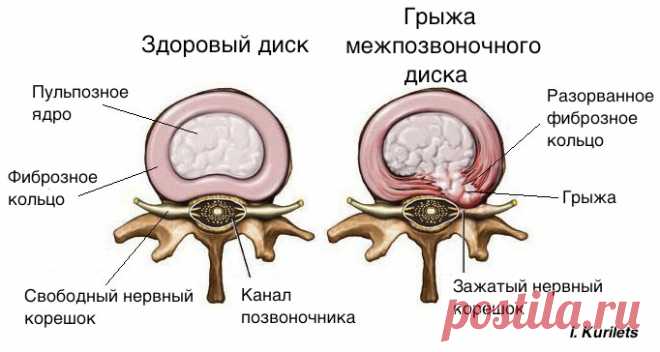 Грыжа диска: вместо операции попробуй это решение! Смотри ВИДЕО - Важное