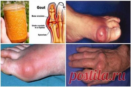 НАРОДНОЕ МОЩНОЕ СРЕДСТВО ИЗБАВЛЕНИЯ ОТ ПОДАГРЫ НАВСЕГДА!