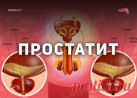 Простатит – это воспалительное заболевание предстательной железы. Проявляется частыми мочеиспусканиями, болевыми ощущениями в области полового члена, мошонки, прямой кишки, сексуальными расстройствами (нарушение эрекции, ранняя эякуляция и т.д.), иногда задержкой мочи, примесью крови в урине.
