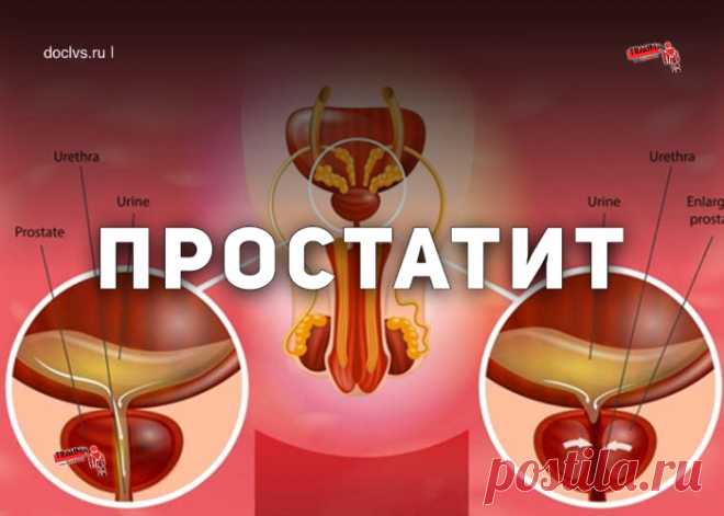 Простатит – это воспалительное заболевание предстательной железы. Проявляется частыми мочеиспусканиями, болевыми ощущениями в области полового члена, мошонки, прямой кишки, сексуальными расстройствами (нарушение эрекции, ранняя эякуляция и т.д.), иногда задержкой мочи, примесью крови в урине.