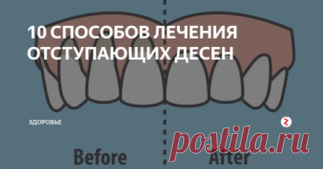 10  СПОСОБОВ ЛЕЧЕНИЯ ОТСТУПАЮЩИХ ДЕСЕН 10 легких способов исцеления отступающих десен
Рецессия десен - это медицинский термин, описывающий, когда край ткани десны, окружающий зуб, отступает назад, подвергая большему количеству зуба или его корня. Отступающие десны могут вызывать заметные промежутки, что облегчает накопление бактерий, вызывающих болезни.
Если их не лечить, поддерживающие ткани и костные структуры зубов могут быть сильно