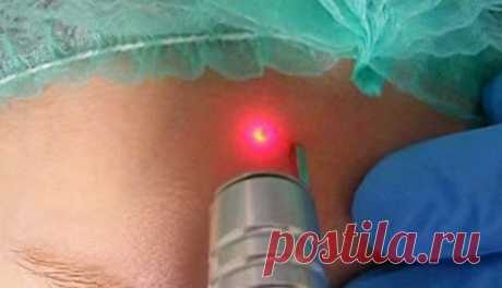 Удаление родинок лазером: цены, последствия
