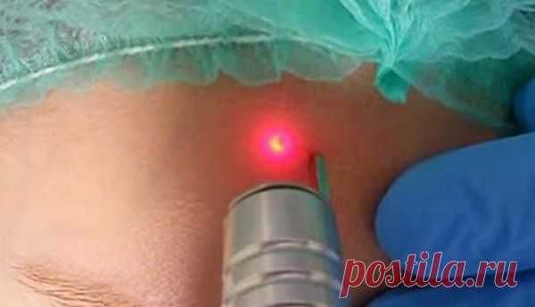 Удаление родинок лазером: цены, последствия