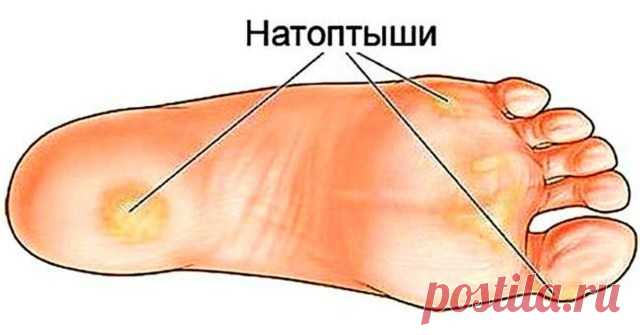 ПРОСТЫЕ РЕЦЕПТЫ ДЛЯ УСТРАНЕНИЯ НАТОПТЫШЕЙ, ТРЕЩИН, МОЗОЛЕЙ, СОСУДИСТОЙ СЕТКИ И ВАРИКОЗА! — Копилочка полезных советов