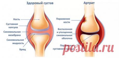 Артроз коленного сустава снимки рентгена