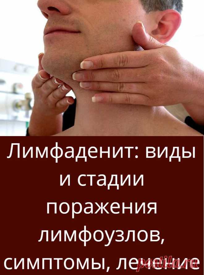 Лимфаденит: виды и стадии поражения лимфоузлов, симптомы, лечение