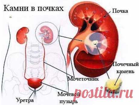 Камни в почках: народное лечение Морковь Гонят камни и песок в почках семена моркови. Их следует перемолоть в порошок и принимать по одному грамму (на кончике ножа) три раза в день за полчаса до еды. Другой способ использования семян моркови при почечнокаменной болезни: 4-5 столовых ложек семян залить одним литром кипятка, настоять в теплом месте 6-8 часов, желательно процедить, и пить настой по 100 мл также до еды, можно 4-5 раз в день или чаще. Семя моркови Петрушка Корни и листья петрушки…