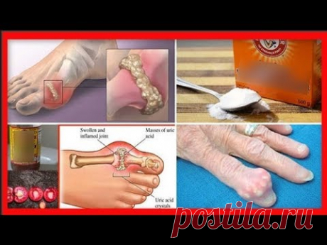 ПОДАГРа и АРТРИТ / ПРИЧИНЫ , ЛЕЧЕНИЕ ПОДАГРЫ АРТРИТА