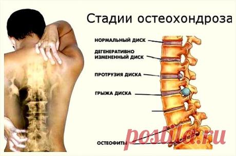 Лечение остеохондроза гомеопатией..