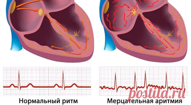 Постоянная форма мерцательной аритмии. Ответы на вопросы. | Кардиолог Константин Крулёв | Дзен