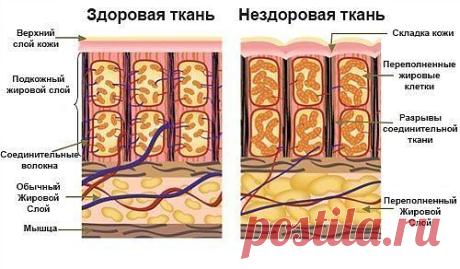 ЗОЖ - народная медицина, рецепты, травы.
Миф о целлюлите.