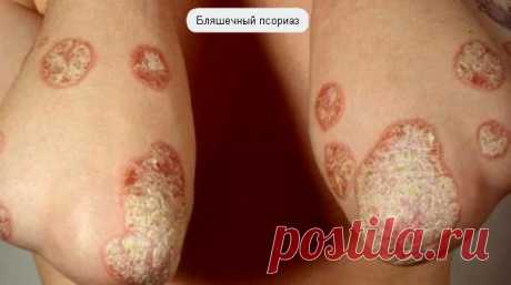 Чешуйчатый лишай: фото, лечение псориаза медикаментозное