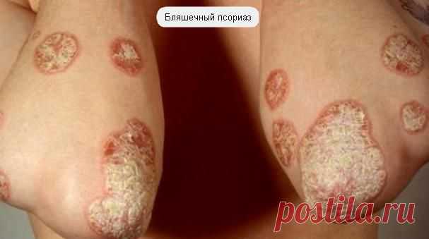 Чешуйчатый лишай: фото, лечение псориаза медикаментозное