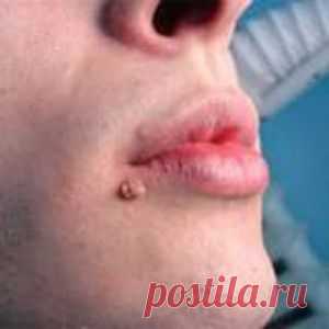 Заговор от висячих родинок, от бородавок и от прыщей....