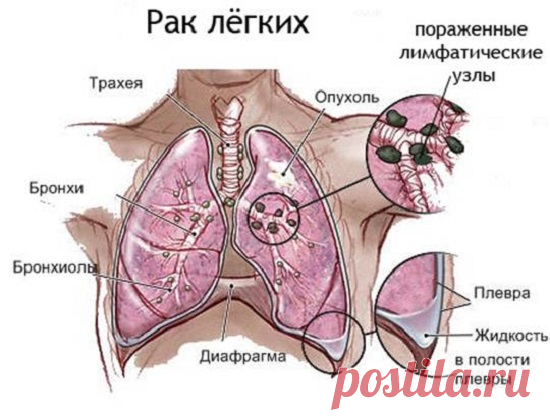 Основные признаки рака легких на ранней стадии у женщин, которые нельзя игнорировать! — ДОМАШНИЕ