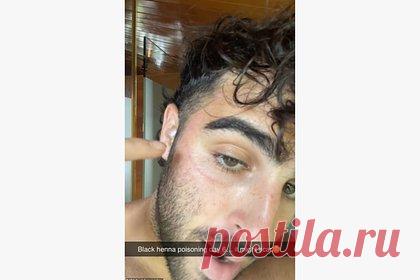 Турист сделал тату на лице во время отдыха в Таиланде и покрылся волдырями