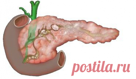 Лечение поджелудочной железы | Домохозяйки
Поджелудочная железа производит ферменты, помогающие перевариванию жиров, белков и углеводов. Клетки поджелудочной железы синтезируют инсулин, глюкагон, соматостатин, панкреатический полипептид. Воспаление поджелудочной железы называется панкреатитом. При данном заболевании ферменты, которые выделяются поджелудочной железой, не выводятся, как в нормальных условиях, в двенадцатиперстную кишку, а воздействуют на саму железу, разрушая ее.