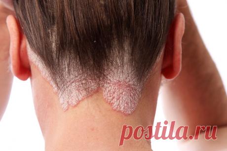 Псориаз: народные методы лечения чешуйчатого лишая