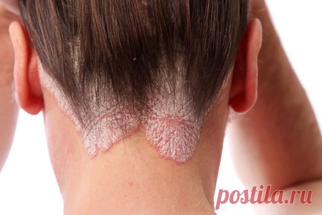 Псориаз: народные методы лечения чешуйчатого лишая