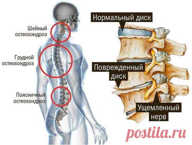 Профилактика остеохондроза: всего 2 ингредиента для здорового позвоночника

Шейный остеохондроз — это вид заболевания, который с трудом поддается лечению.

Даже, если Вы делаете зарядку каждый день, то для максимального результата я рекомендую попробовать этот метод лечения. После его использования Вы не ощутите боль в течении нескольких месяцев!

Готовим целебную массажную массу! Вам понадобится нерафинированное растительное масло и мелкая соль (можно взять морскую).

Как...