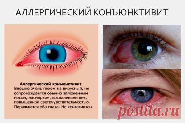 Аллергический конъюнктивит: лечение у взрослых, симптомы (фото), причины, виды (поллинозный, хронический, весенний, сезонный, туберкулезный, кератоконъюнктивит, блефароконъюнктивит)